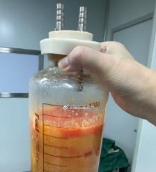 宁津水动力吸脂手术要做多久？